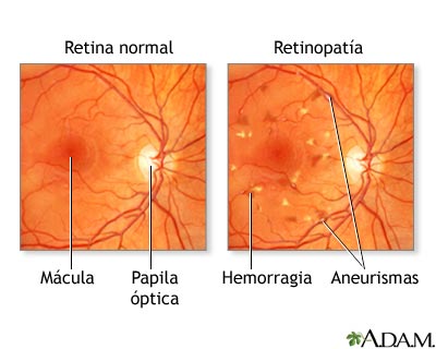 retinopatia-diabetica.jpg